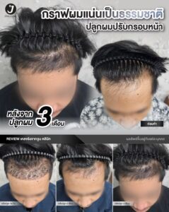 รีวิวปลูกผม 7