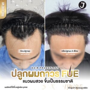 รีวิวปลูกผม 9