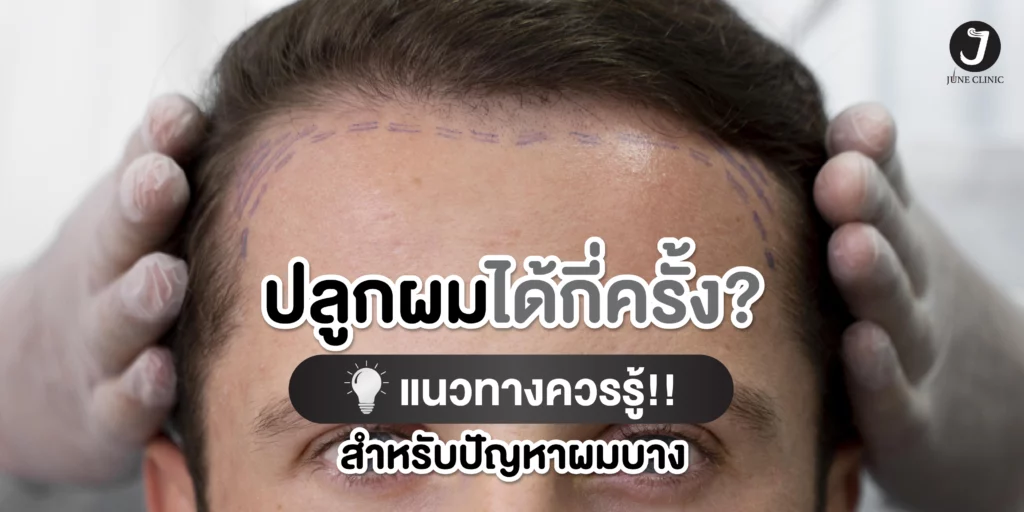 ปลูกผมได้กี่ครั้ง