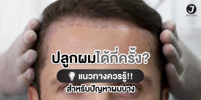 ปลูกผมได้กี่ครั้ง ปลูกผมได้กี่ครั้ง