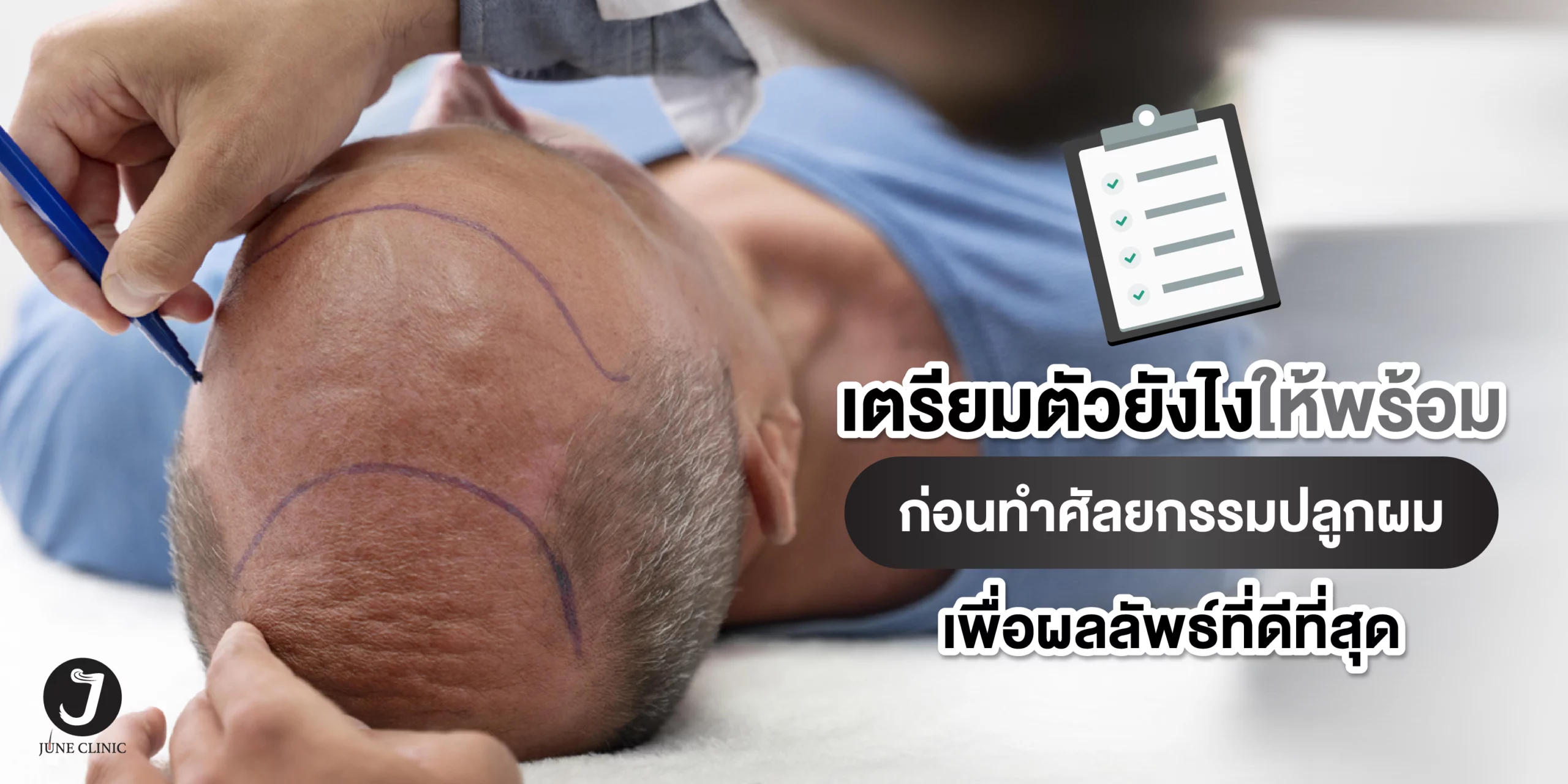 เตรียมตัวก่อนปลูกผม